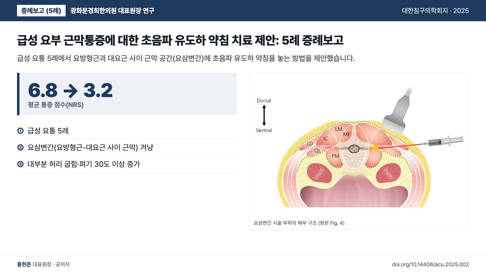 급성 요부 근막통증에 대한 초음파 유도하 약침 치료 제안: 5례 증례보고 — 급성 요통 5례에서 요방형근과 대요근 사이 근막 공간(요삼변간)에 초음파 유도하 약침을 놓는 방법을 제안했습니다.