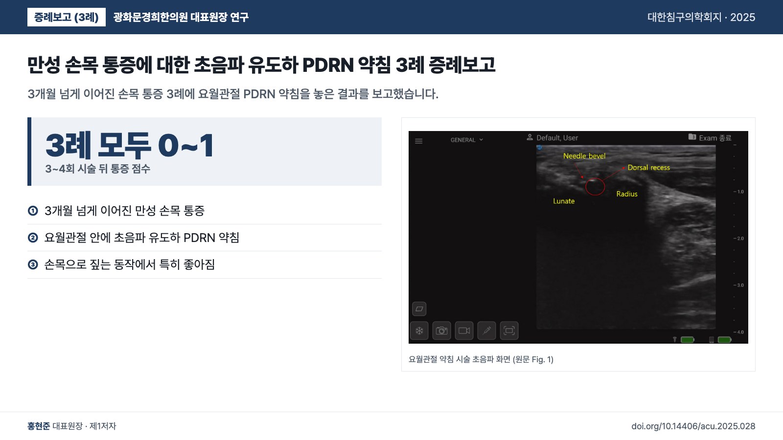 만성 손목 통증에 대한 초음파 유도하 PDRN 약침 3례 증례보고 — 3개월 넘게 이어진 손목 통증 3례에 요월관절 PDRN 약침을 놓은 결과를 보고했습니다.
